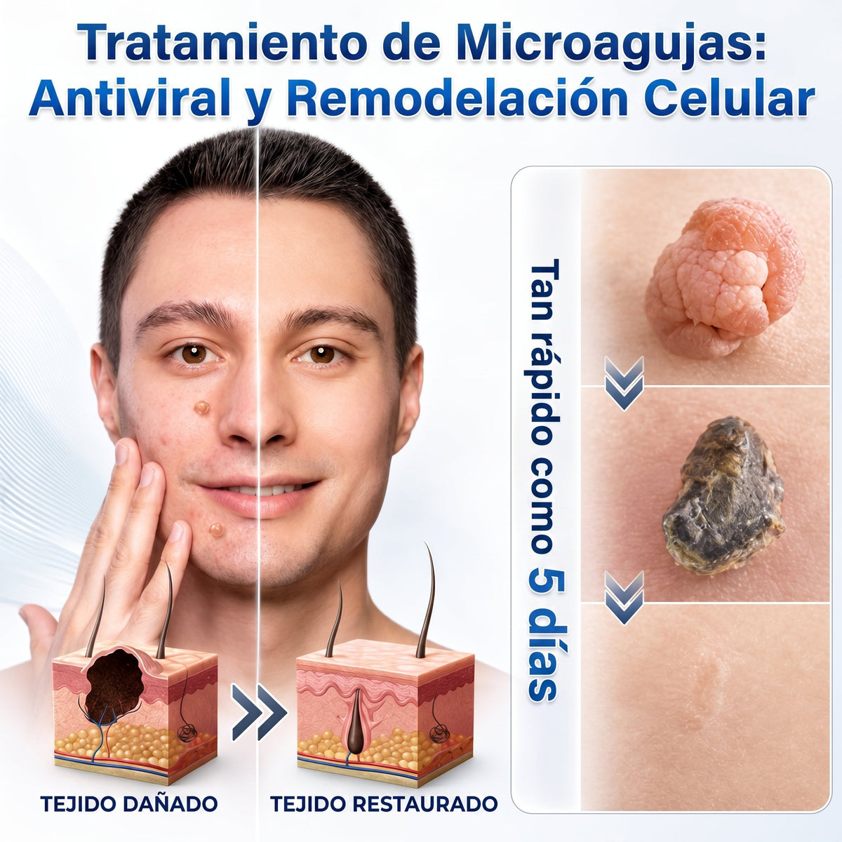 🍔🧃𝑻𝒊𝒆𝒏𝒅𝒂 𝑶𝒇𝒊𝒄𝒊𝒂𝒍 | 𝐕𝐄𝐋𝐍𝐎𝐑𝐀® 🌿 𝑀𝑖𝑐𝑟𝑜𝑎𝑔𝑢𝑗𝑎𝑠 𝑃𝑖𝑒𝑙 𝐼𝑚𝑝𝑒𝑐𝑎𝑏𝑙𝑒 𝐸𝑙𝑖𝑚𝑖𝑛𝑎𝑐𝑖ó𝑛 𝐷𝑒 𝑉𝑒𝑟𝑟𝑢𝑔𝑎𝑠 𝑃𝑎𝑟𝑐ℎ𝑒 (𝑃𝑎𝑟𝑎 𝑎𝑐𝑟𝑜𝑐𝑜𝑟𝑑𝑜𝑛𝑒𝑠, 𝑝𝑒𝑞𝑢𝑒ñ𝑎𝑠 𝑖𝑚𝑝𝑒𝑟𝑓𝑒𝑐𝑐𝑖𝑜𝑛𝑒𝑠 𝑐𝑢𝑡á𝑛𝑒𝑎𝑠, 𝑣𝑒𝑟𝑟𝑢𝑔𝑎𝑠, 𝑙𝑢𝑛𝑎𝑟𝑒𝑠, 𝑚𝑎𝑛𝑐ℎ𝑎𝑠 𝑑𝑒 𝑙𝑎 𝑒𝑑𝑎𝑑 𝑦 𝑝𝑟𝑜𝑏𝑙𝑒𝑚𝑎𝑠 𝑑𝑒 𝑝𝑖𝑔𝑚𝑒𝑛𝑡𝑎𝑐𝑖ó𝑛.)