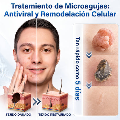 🍔🧃𝑻𝒊𝒆𝒏𝒅𝒂 𝑶𝒇𝒊𝒄𝒊𝒂𝒍 | 𝐕𝐄𝐋𝐍𝐎𝐑𝐀® 🌿 𝑀𝑖𝑐𝑟𝑜𝑎𝑔𝑢𝑗𝑎𝑠 𝑃𝑖𝑒𝑙 𝐼𝑚𝑝𝑒𝑐𝑎𝑏𝑙𝑒 𝐸𝑙𝑖𝑚𝑖𝑛𝑎𝑐𝑖ó𝑛 𝐷𝑒 𝑉𝑒𝑟𝑟𝑢𝑔𝑎𝑠 𝑃𝑎𝑟𝑐ℎ𝑒 (𝑃𝑎𝑟𝑎 𝑎𝑐𝑟𝑜𝑐𝑜𝑟𝑑𝑜𝑛𝑒𝑠, 𝑝𝑒𝑞𝑢𝑒ñ𝑎𝑠 𝑖𝑚𝑝𝑒𝑟𝑓𝑒𝑐𝑐𝑖𝑜𝑛𝑒𝑠 𝑐𝑢𝑡á𝑛𝑒𝑎𝑠, 𝑣𝑒𝑟𝑟𝑢𝑔𝑎𝑠, 𝑙𝑢𝑛𝑎𝑟𝑒𝑠, 𝑚𝑎𝑛𝑐ℎ𝑎𝑠 𝑑𝑒 𝑙𝑎 𝑒𝑑𝑎𝑑 𝑦 𝑝𝑟𝑜𝑏𝑙𝑒𝑚𝑎𝑠 𝑑𝑒 𝑝𝑖𝑔𝑚𝑒𝑛𝑡𝑎𝑐𝑖ó𝑛.)
