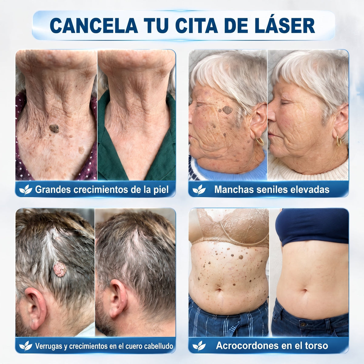 🍔🧃𝑻𝒊𝒆𝒏𝒅𝒂 𝑶𝒇𝒊𝒄𝒊𝒂𝒍 | 𝐕𝐄𝐋𝐍𝐎𝐑𝐀® 🌿 𝑀𝑖𝑐𝑟𝑜𝑎𝑔𝑢𝑗𝑎𝑠 𝑃𝑖𝑒𝑙 𝐼𝑚𝑝𝑒𝑐𝑎𝑏𝑙𝑒 𝐸𝑙𝑖𝑚𝑖𝑛𝑎𝑐𝑖ó𝑛 𝐷𝑒 𝑉𝑒𝑟𝑟𝑢𝑔𝑎𝑠 𝑃𝑎𝑟𝑐ℎ𝑒 (𝑃𝑎𝑟𝑎 𝑎𝑐𝑟𝑜𝑐𝑜𝑟𝑑𝑜𝑛𝑒𝑠, 𝑝𝑒𝑞𝑢𝑒ñ𝑎𝑠 𝑖𝑚𝑝𝑒𝑟𝑓𝑒𝑐𝑐𝑖𝑜𝑛𝑒𝑠 𝑐𝑢𝑡á𝑛𝑒𝑎𝑠, 𝑣𝑒𝑟𝑟𝑢𝑔𝑎𝑠, 𝑙𝑢𝑛𝑎𝑟𝑒𝑠, 𝑚𝑎𝑛𝑐ℎ𝑎𝑠 𝑑𝑒 𝑙𝑎 𝑒𝑑𝑎𝑑 𝑦 𝑝𝑟𝑜𝑏𝑙𝑒𝑚𝑎𝑠 𝑑𝑒 𝑝𝑖𝑔𝑚𝑒𝑛𝑡𝑎𝑐𝑖ó𝑛.)